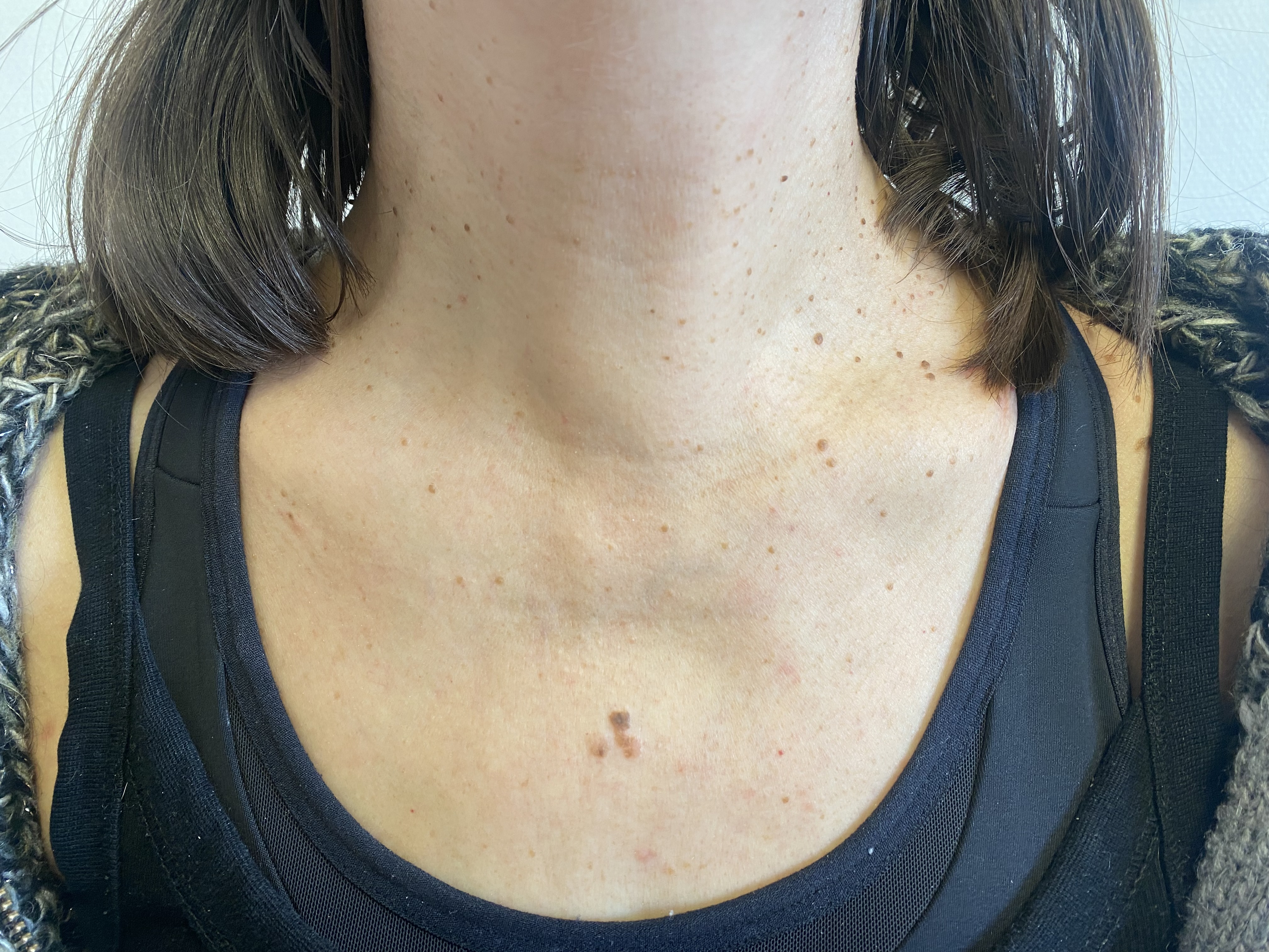 Cirugía sin cicatriz